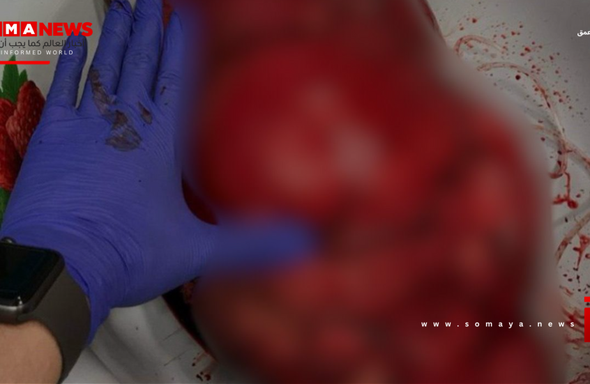 بعملية معقّدة.. أطباء روس ينجحون باستئصال ورم عملاق من جسم امرأة (فيديو)