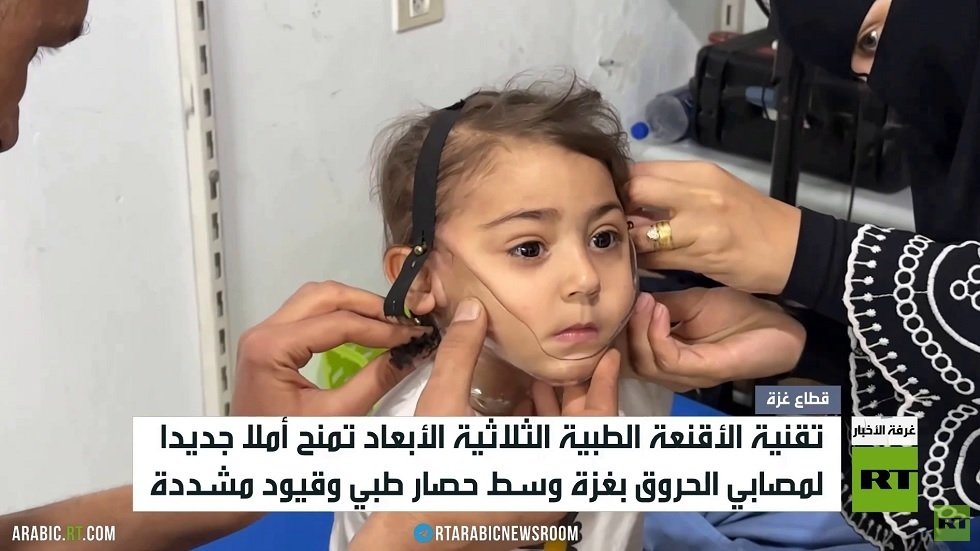 أقنعة ثلاثية الأبعاد تفتح آفاقاً جديدة لعلاج مصابي الحروق