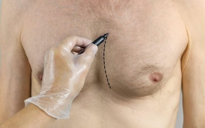 تثدي الرجل يزيد خطر الإصابة بالسرطان 3-5 مرات