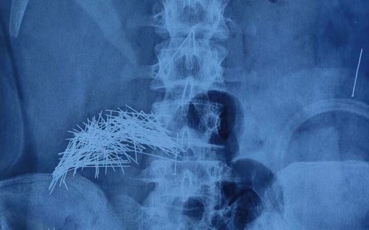 العراق.. أطباء يستخرجون 214 إبرة من بطن مريض في عملية نادرة