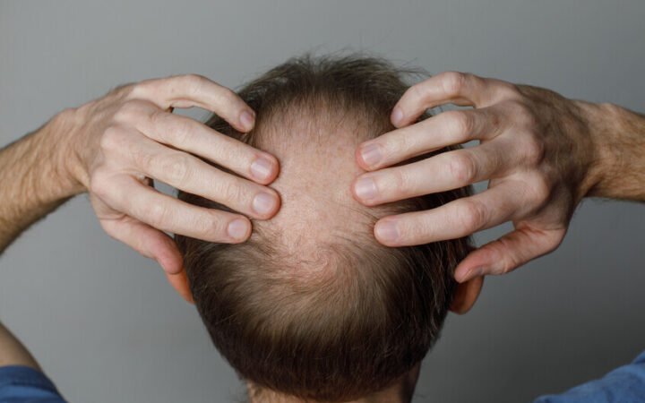 حبوب جديدة تحقق نتائج واعدة في علاج الصلع الذكوري في 6 أشهر